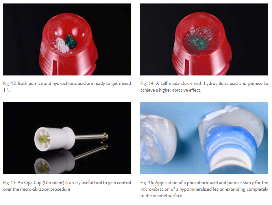 Fig. 13: Both pumice and hydrochloric acid are ready to get mixed 1:1.  Fig. 15: An OpalCup (Ultradent) is a very useful tool to gain control over the micro-abrasion procedure.  Fig. 14: A self-made slurry with hydrochloric acid and pumice to achieve a higher abrasive effect.  Fig. 16: Application of a phosphoric acid and pumice slurry for the micro-abrasion of a hypomineralised lesion extending completely to the enamel surface.